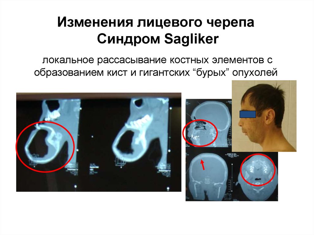 Изменения лицевого черепа Синдром Sagliker локальное рассасывание костных элементов с образованием кист и гигантских “бурых”