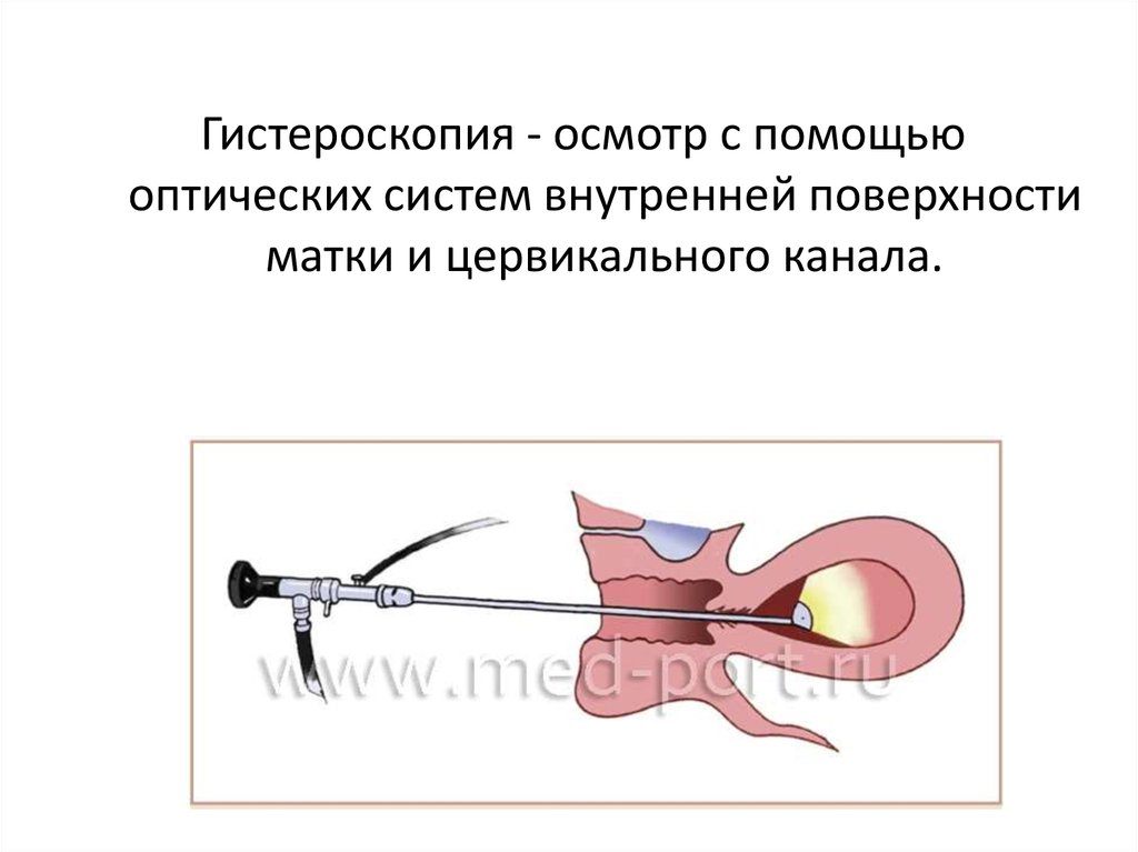 Сосудистый рисунок не выражен при гистероскопии что это