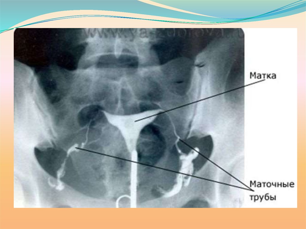 Сколько труб у женщины. Рентген снимок маточных труб. Непроходимость маточных труб снимок ГСГ. Гистеросальпингография непроходимость маточных труб. Непроходимость маточных труб УЗИ.
