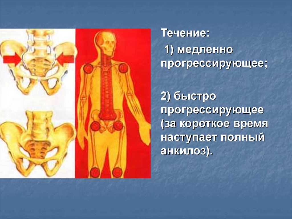 Болезнь бехтерева презентация госпитальная терапия