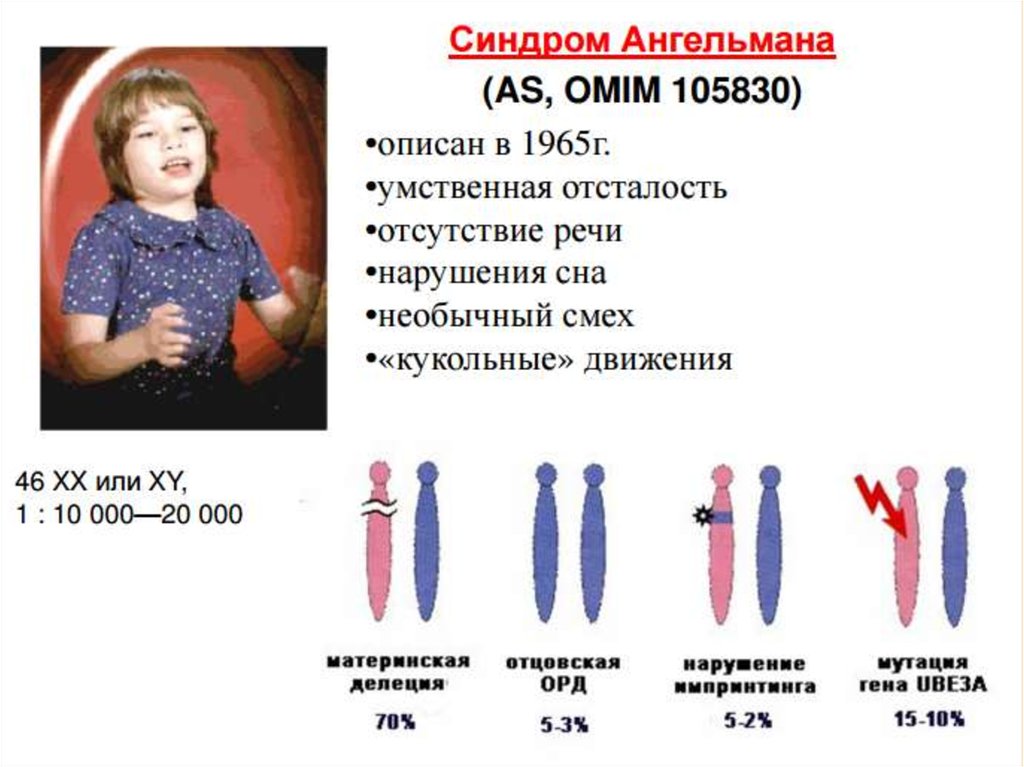 Синдром ангельмана презентация по генетике