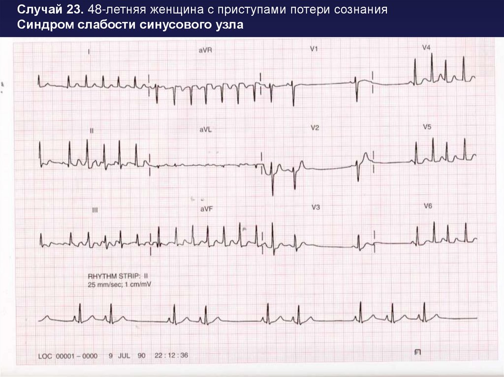 Синдром слабости синусового узла карта вызова смп