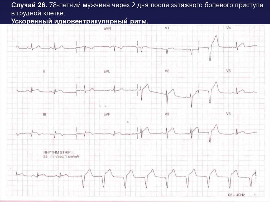 Ритм проводимости. Идиовентрикулярный ритм нарушение проводимости. Ускоренный идиовентрикулярный ритм купирование приступа. Ускоренный идиовентрикулярный ритм какой класс градации ЖЭС?.