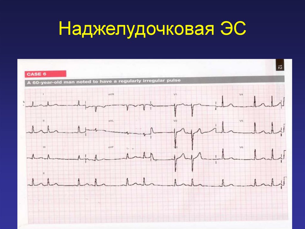 Экстрасистолы таблетки