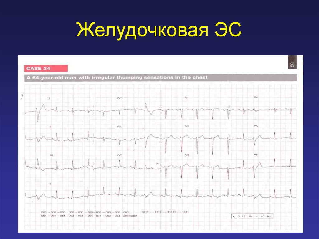 Желудочковые нарушения ритма клинические. Полиморфная желудочковая экстрасистолия. Классификация аритмий. Классификация аритмий сердца. Нарушение ритма и проводимости презентация.