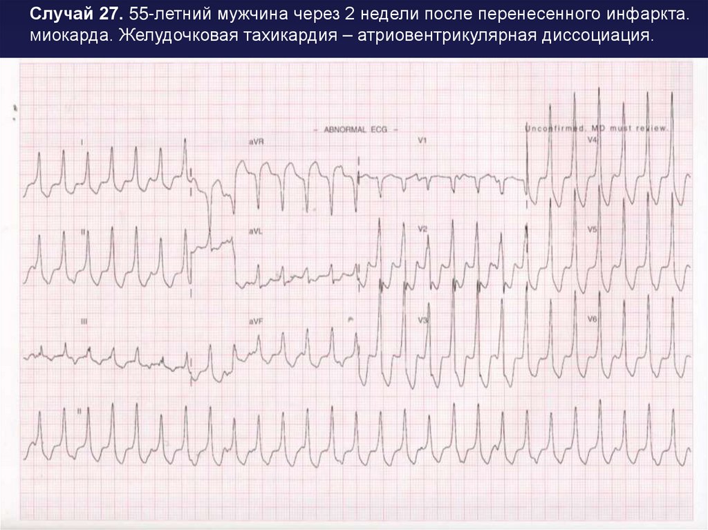 Пароксизмальная желудочковая тахикардия карта вызова смп