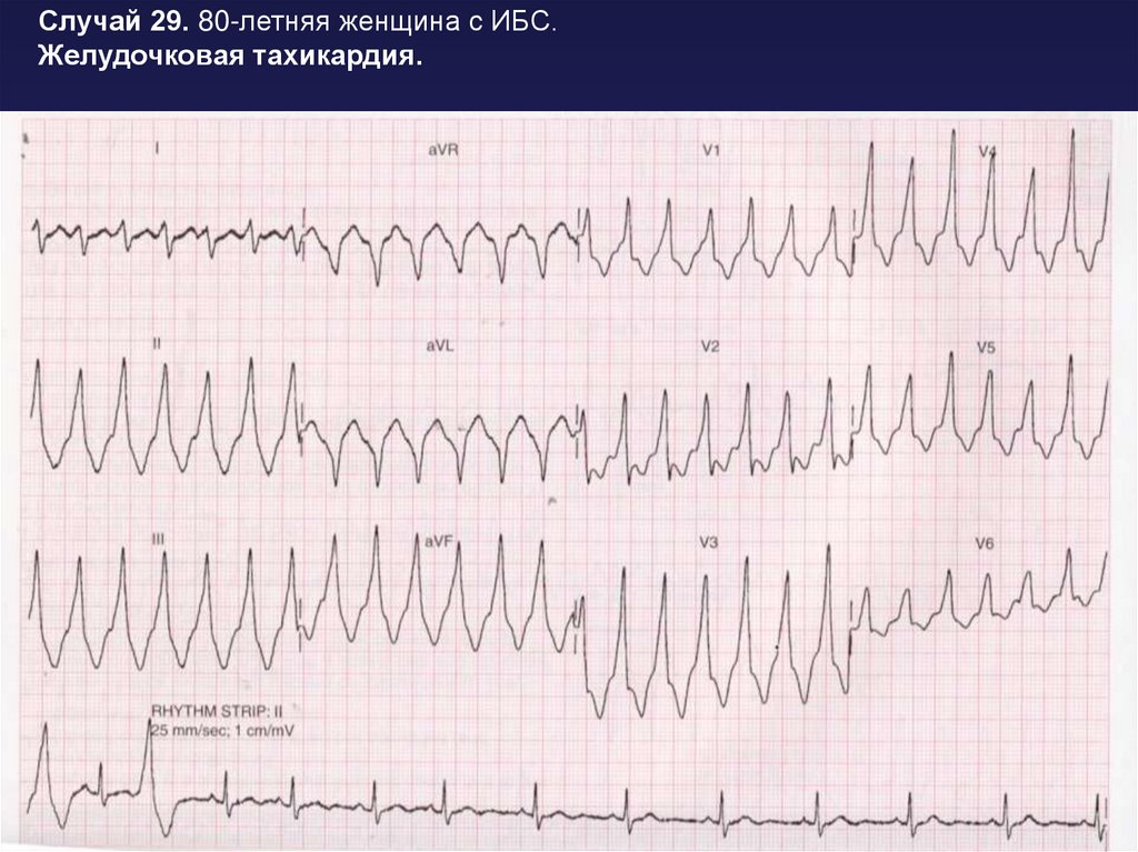Тахикардия типа пируэт. ИБС С нарушением ритма по типу желудочковой экстрасистолии. ИБС желудочковая тахикардия. Экстрасистолия, аритмия, тахикардия. Нарушения ритма сердца схема.