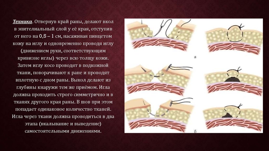 Сведение краев раны. Края раны адаптированы швами. Иссечение ЭКХ С подшиванием краев раны ко дну.