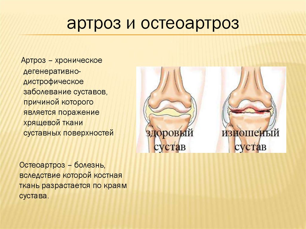 Лечение остеоартроза презентация