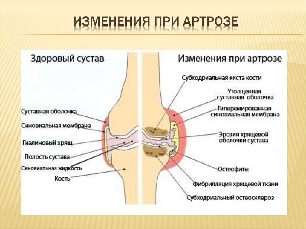 Рентгенологическая картина остеоартроза