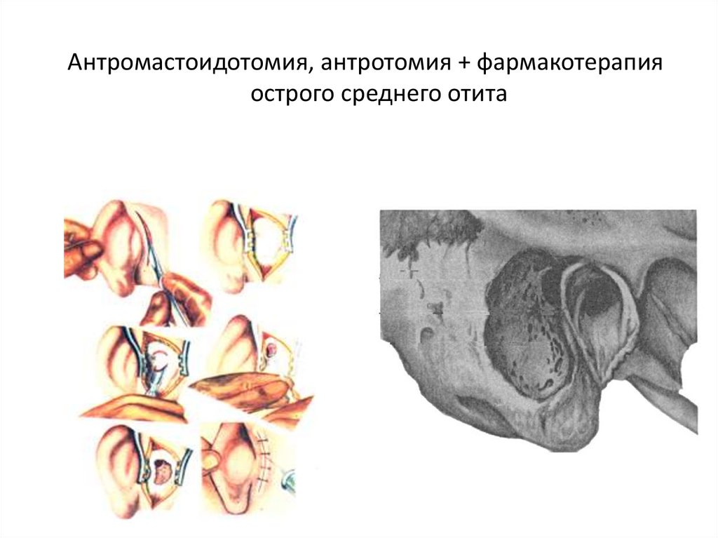 Трепанационный треугольник шипо схема