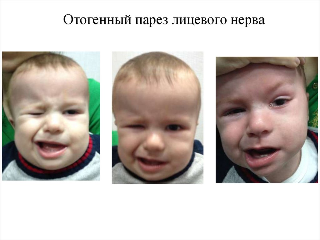 Неврит лицевого нерва у детей. Врожденный паралич лицевого нерва. Парез лицевого нерва у ребенка. Врожденный парез лицевого нерва.