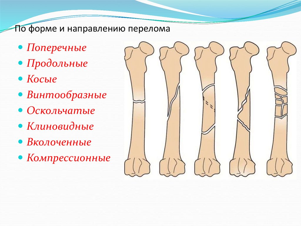 Типы закрытых переломов. Классификация переломов по направлению линии перелома. Классификация переломов по линии излома. Классификация переломов по характеру повреждения кости. Классификация переломов костей конечностей.