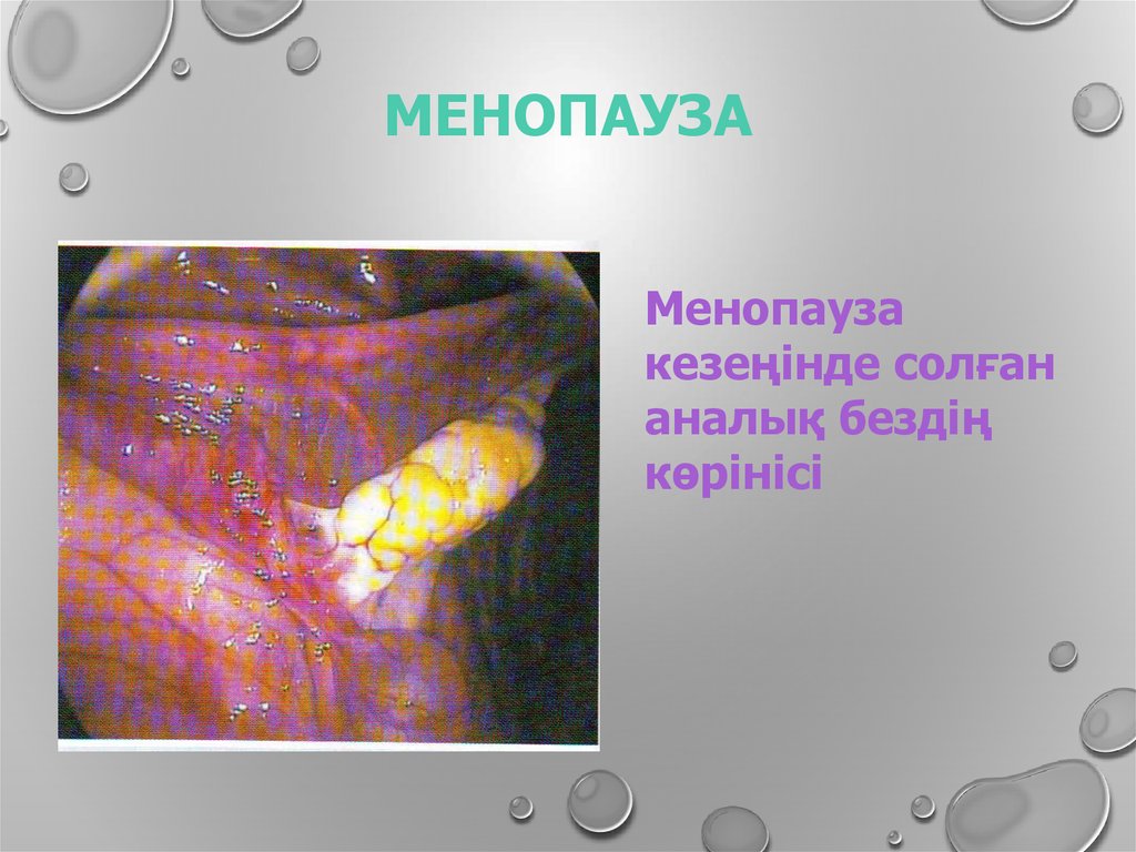 Менопауза