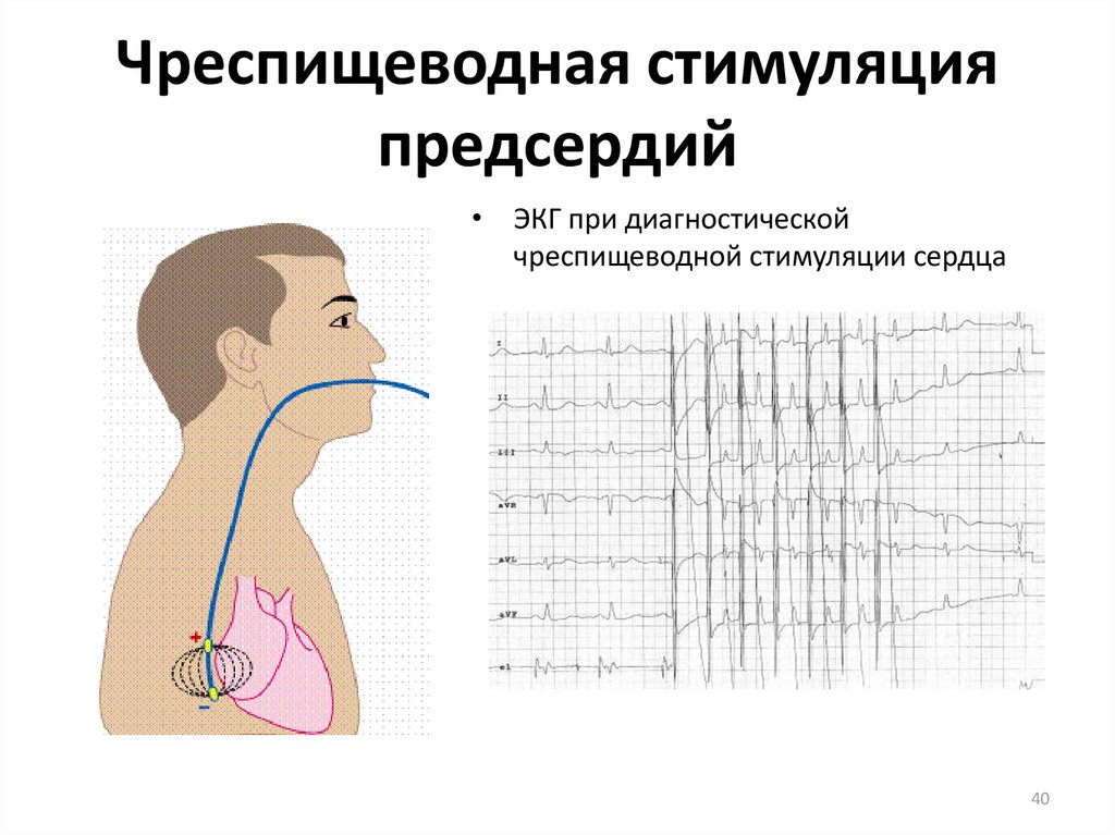 Эх экг. Чреспищеводная стимуляция предсердий. Чреспищеводная электрическая стимуляция сердца. Чреспищеводная электрокардиостимуляция сердца. Электрокардиография (ЭКГ) (чреспищеводная (ЧПЭКГ)).