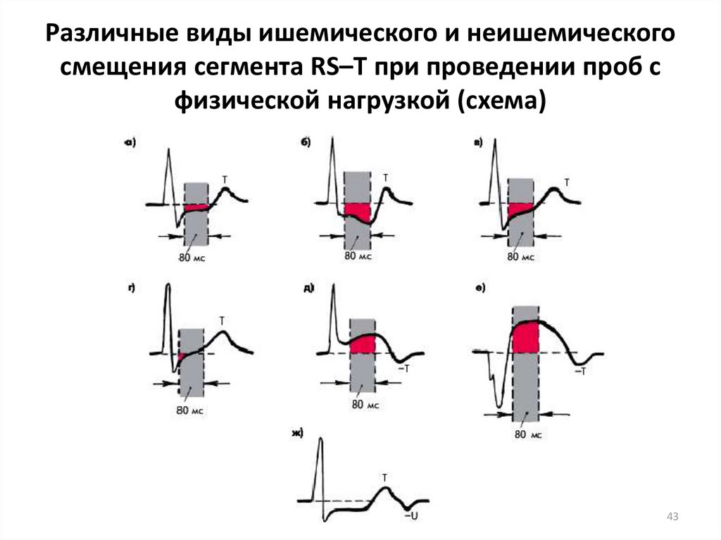 Депрессия st. Ишемическое смещение сегмента St что это такое. Депрессия сегмента RS-T. Смещение сегмента St при ИБС. Смещение сегмента RS–T.