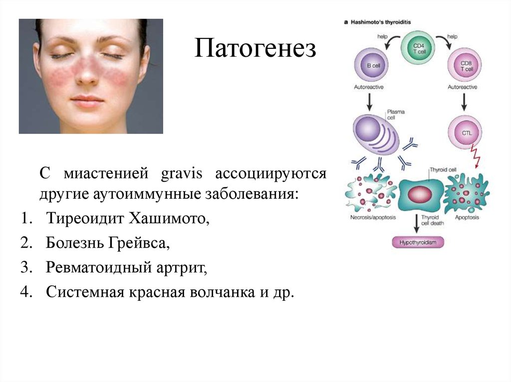 Хашимото болезнь у женщин. Аутоиммунный тиреоидит Хашимото патогенез. Системная красная волчанка патогенез патофизиология.