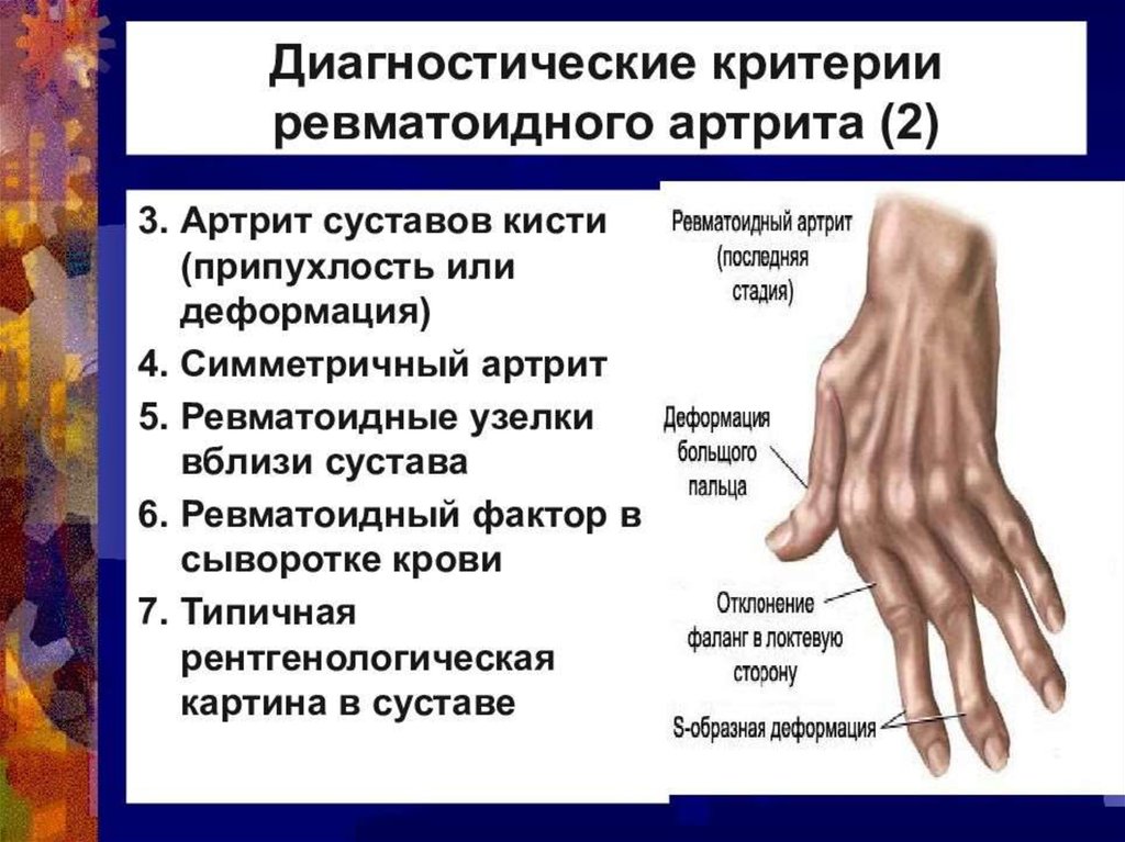 Ревматоидный артрит мышцы. Суставные поражения при ревматоидном артрите. Ревматоидный артрит симметричное поражение суставов. Ювенильный ревматоидный артрит клиническая картина. Симптомы поражения суставов ревматоидного артрита.