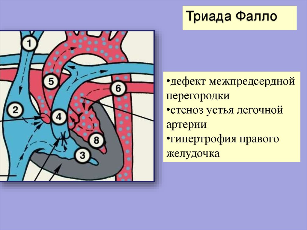 Триада фалло презентация