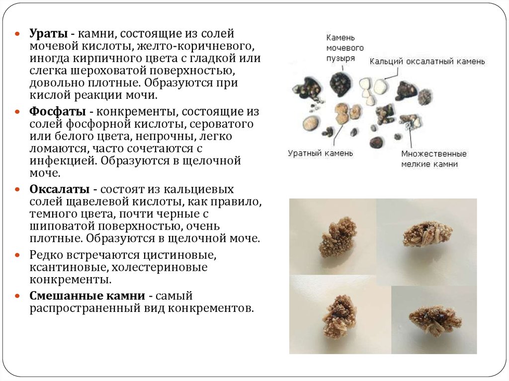 Кристаллы кальция в моче у мужчин. Мочевой камень состоит из мочевой кислоты. Камни в почках, камни в моче. Мочевые камни фосфаты Ураты. Ураты фосфаты оксалаты мочекаменная болезнь.