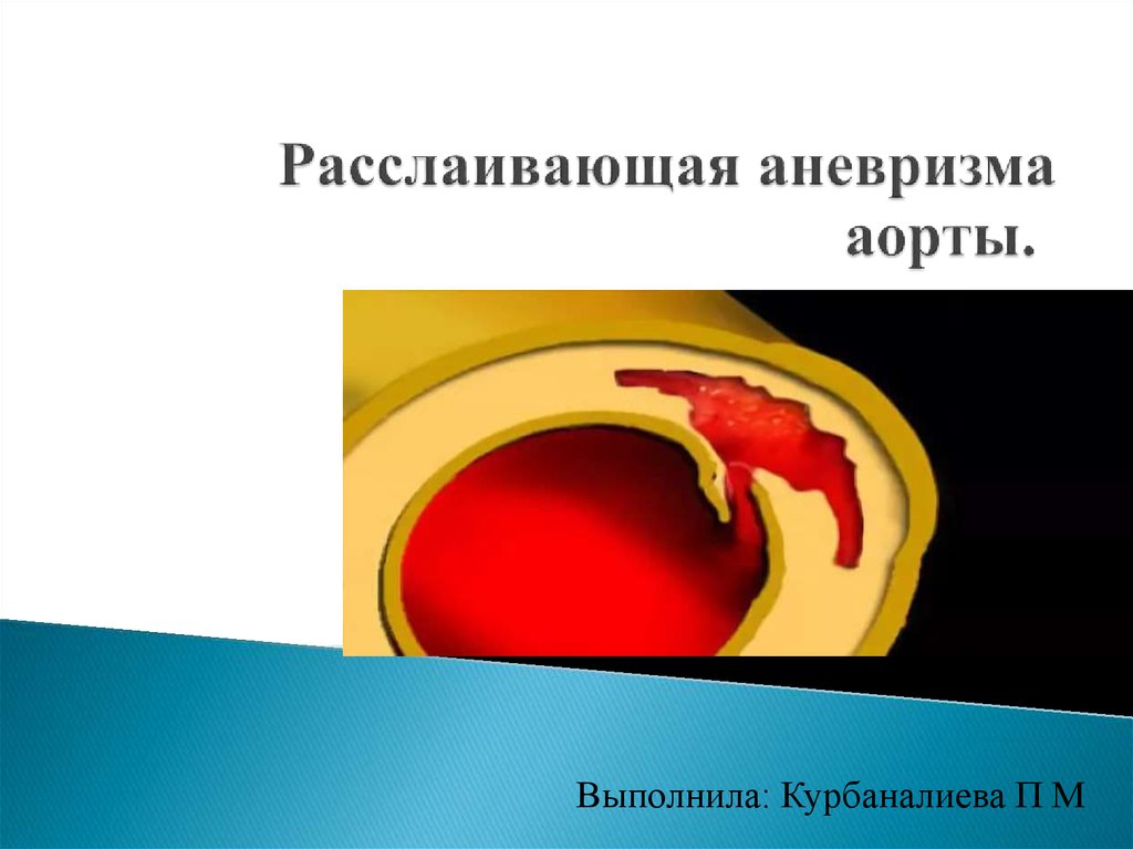 Расслаивающая аневризма аорты. Расслаивающая аневризма грудного отдела. Расслаивающаяся аневризма аорты. Расслаивающих аневризм аорты. Расслаивающаяся аневризма аорты клиника.