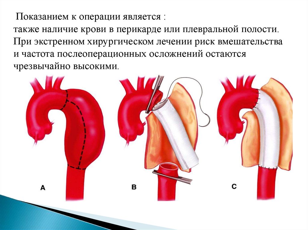 Операция на сосуды. Расслаивающая аневризма аорты операция. Операция протезирования аорты. Аневризма аорты сердца операция.