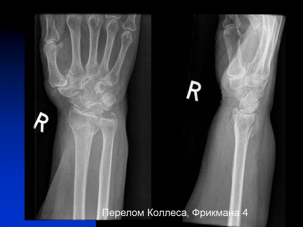 Перелом лучевой кости в типичном месте. Перелом луча в типичном месте коллеса Смита. Перелом лучевой кости рентген. Перелом Коллиса рентген. Перелом коллеса лучевой кости.