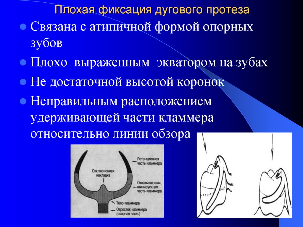 Плохо выражена. Ошибки и осложнения при протезировании. Ошибки и осложнения при протезировании бюгельными протезами. Ошибки и осложнения при ортопедическом лечении. Способы предупреждения осложнений при фиксации животных.