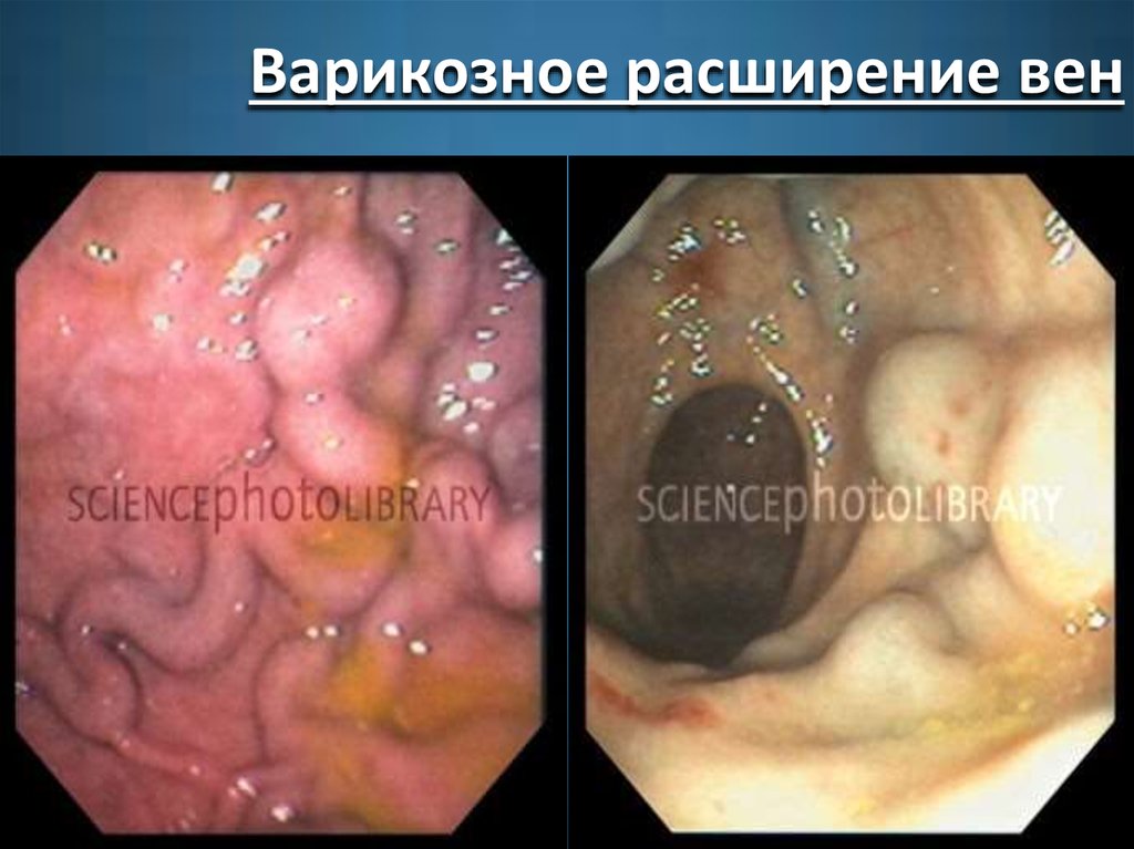Варикозное расширение вен
