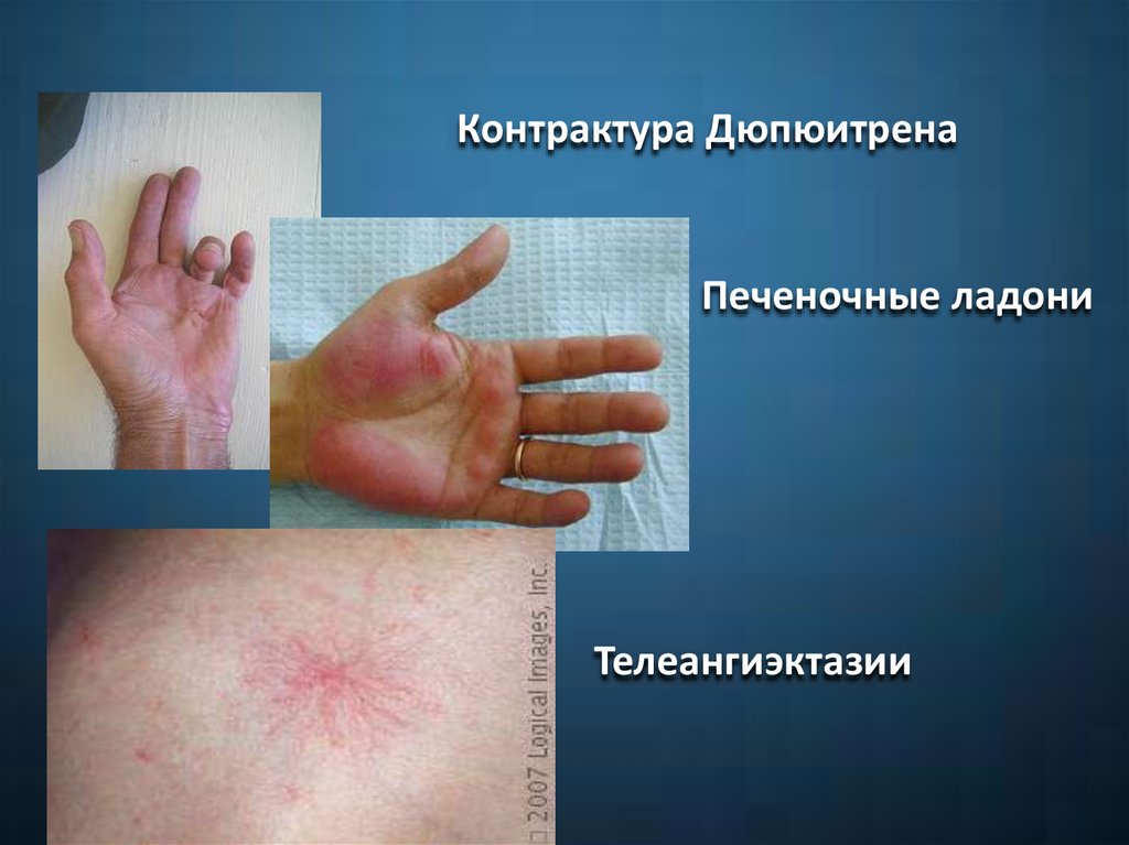 Контрактура Дюпюитрена