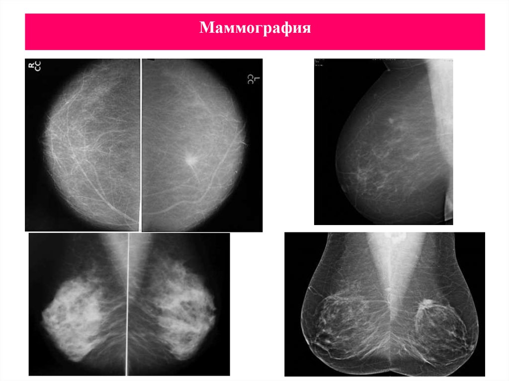Маммография сергиев. Маммография. Маммография скрининг. Маммография рентген. Маммография в трех проекциях.