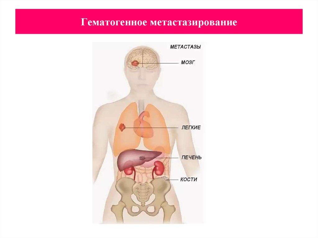 Рак молочной железы метастазы лечение. Гематогенное метастазирование. Гематогенный путь метастазирования. Гематогкнные метастазы раза молочнфй железы. Лимфогенное и гематогенное метастазирование.