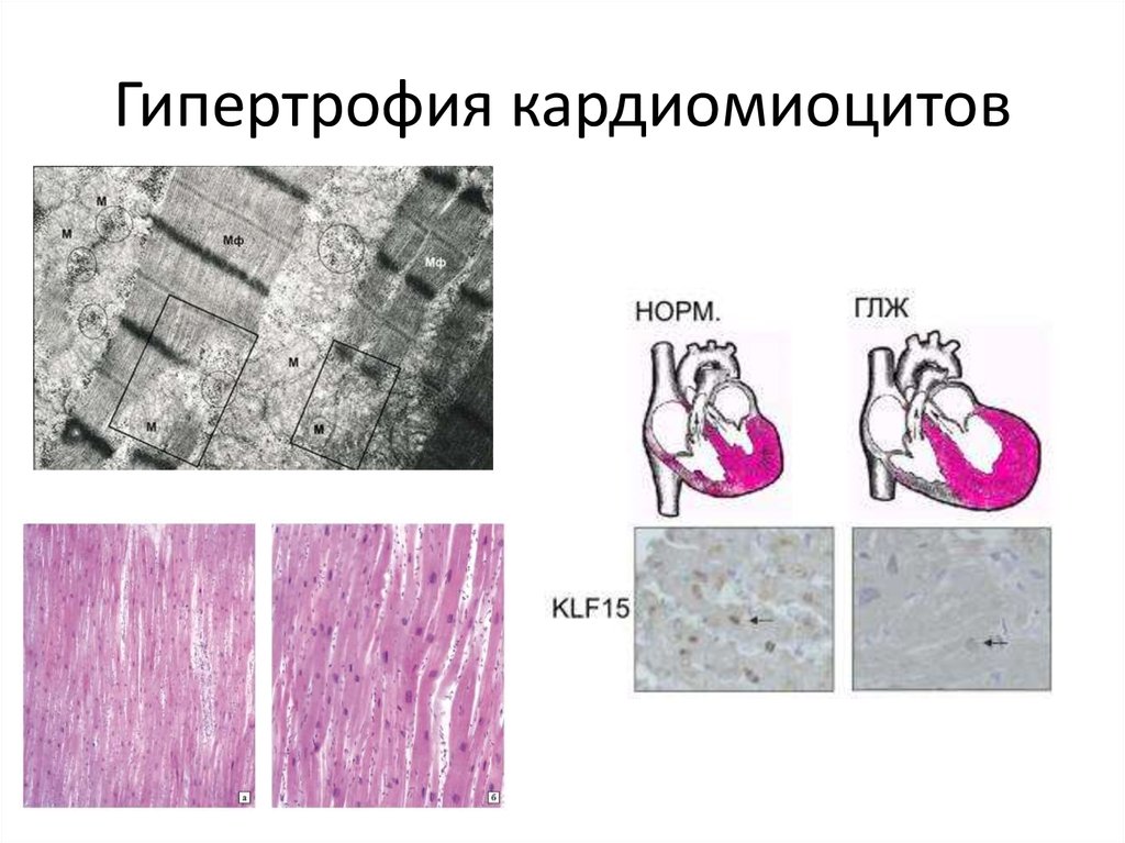 Гипертрофия миокарда рисунок