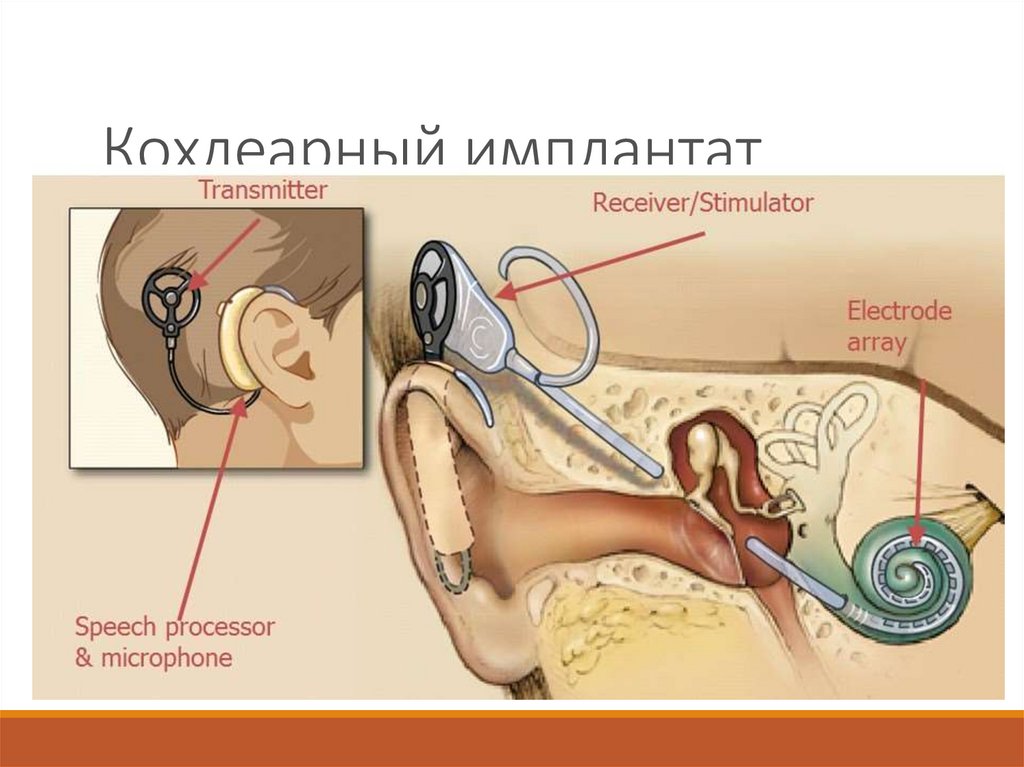 Операция на ухо на слух