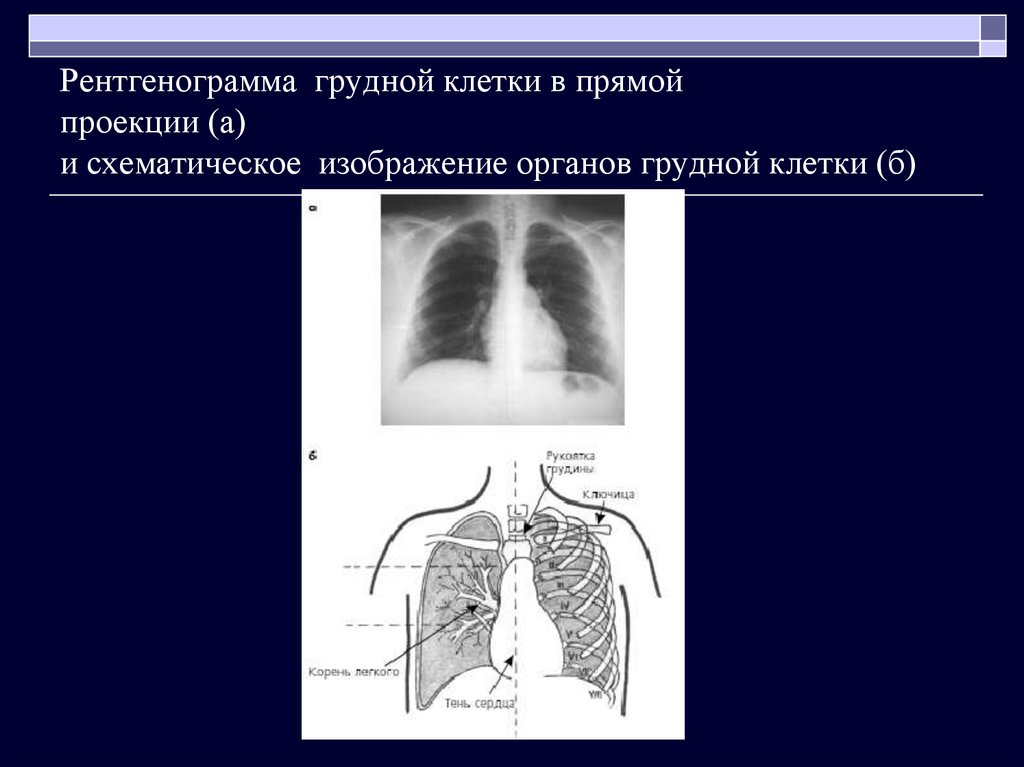 Прямая проекция рентгенограмма. Рентгенография грудной клетки (в 1-й проекции). Рентгенограмма грудной клетки в прямой проекции. Рентгенография грудной клетки в прямой проекции. Задняя проекция грудной клетки рентген.