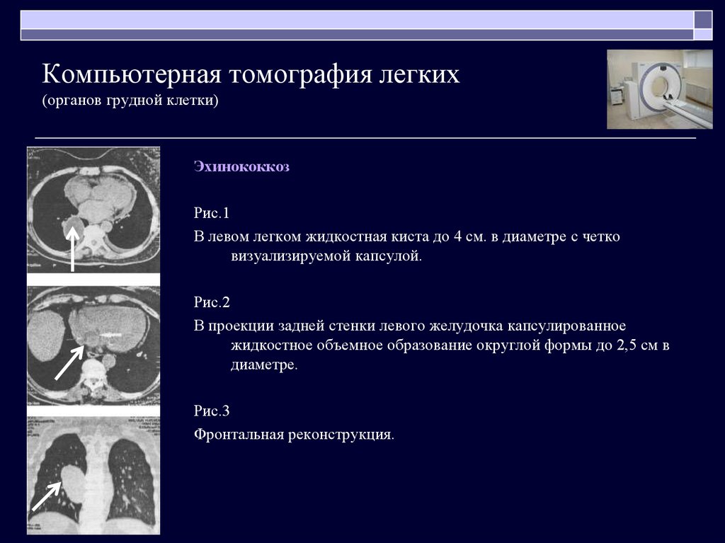 Что показывает кт. Кт грудной клетки проекции. Режимы кт легких. Кт грудной клетки в легочном режиме. Кт томограмма легких в проекциях.