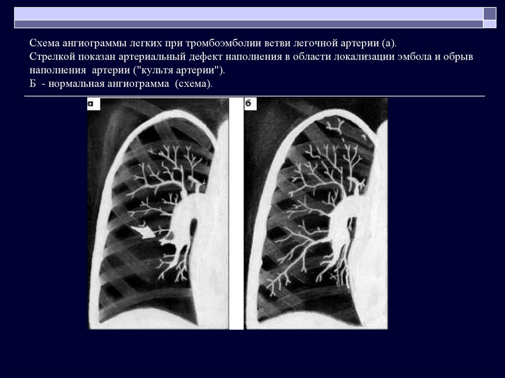 Ветви в легких. Рентген картина тромбоэмболии легочной артерии. Тромбоэмболия ветвей легочной артерии кт. Тромбоэмболия легочной артерии рентген. Рентгенография легких при Тэла.