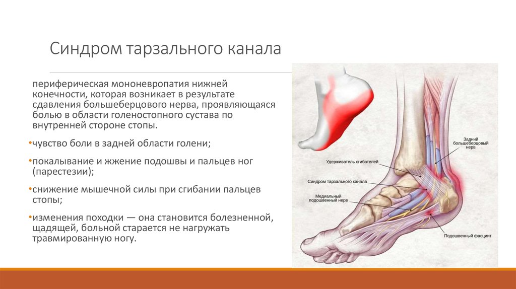 Подошвенная нейропатия. Туннельный синдром большеберцового нерва. Синдром тарзального канала большеберцового нерва. Синдром тарзального канала стопы. Синдром тарзального канала нерв.