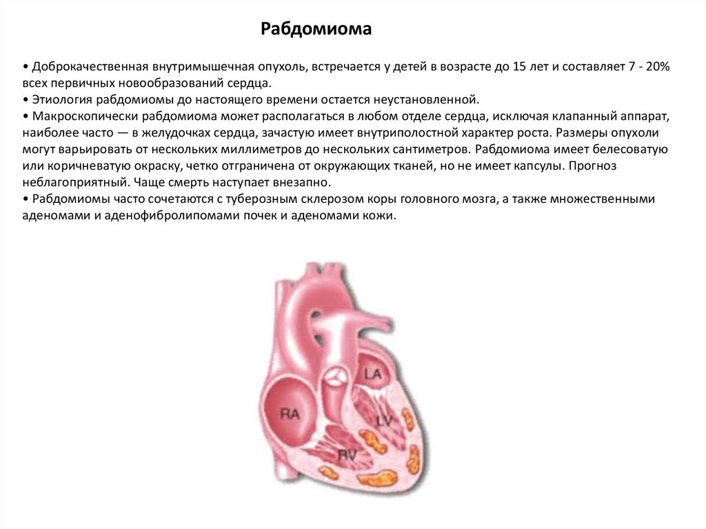Рабдомиома сердца. Рабдомиома сердца у плода. Рабдомиома патологическая анатомия.