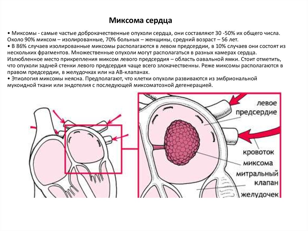 Опухоль правого. Опухоль сердца миксома. Доброкачественная опухоль сердца миксома. Миксома левого предсердия. Опухоли правого предсердия.