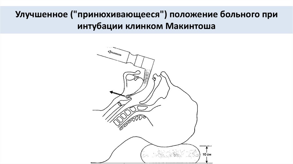 Положение улучшилось. Положение клинка при интубации. Улучшенное положение при интубации. Улучшенное джексоновское положение при интубации. Принюхивающееся положение при интубации.