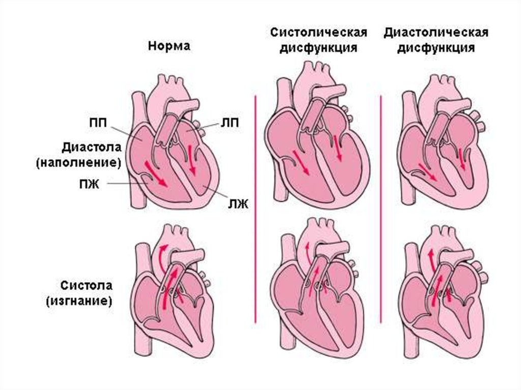 Дисфункции желудочков сердца