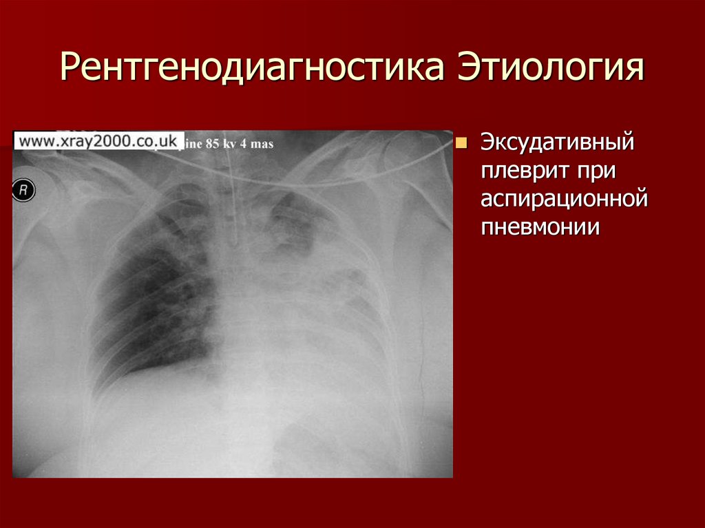 Образования в легких человека. Рентгенодиагностика плевритов стадии. Рентгенодиагностика картинки. Рентгенодиагностика легких книга.