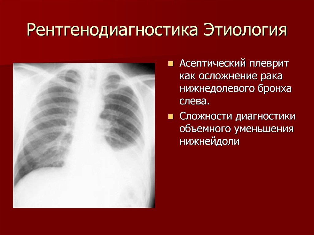 Плеврит легких что это симптомы. Туберкулезный плеврит рентгенодиагностика. Идиопатический плеврит.