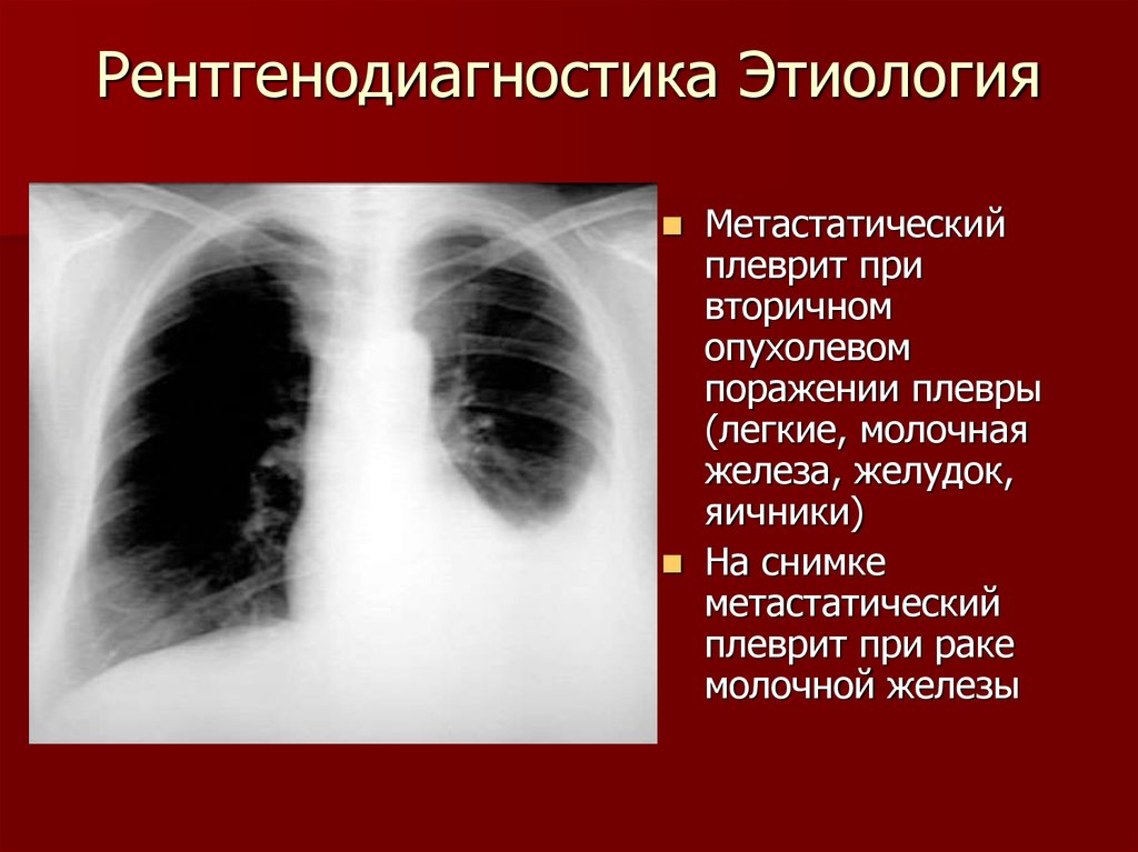 Экссудативный плеврит при пневмонии. Туберкулезный плеврит рентген. Субтотальный плеврит рентген. Плеврит при пневмонии рентген. Апикальный плеврит рентген.