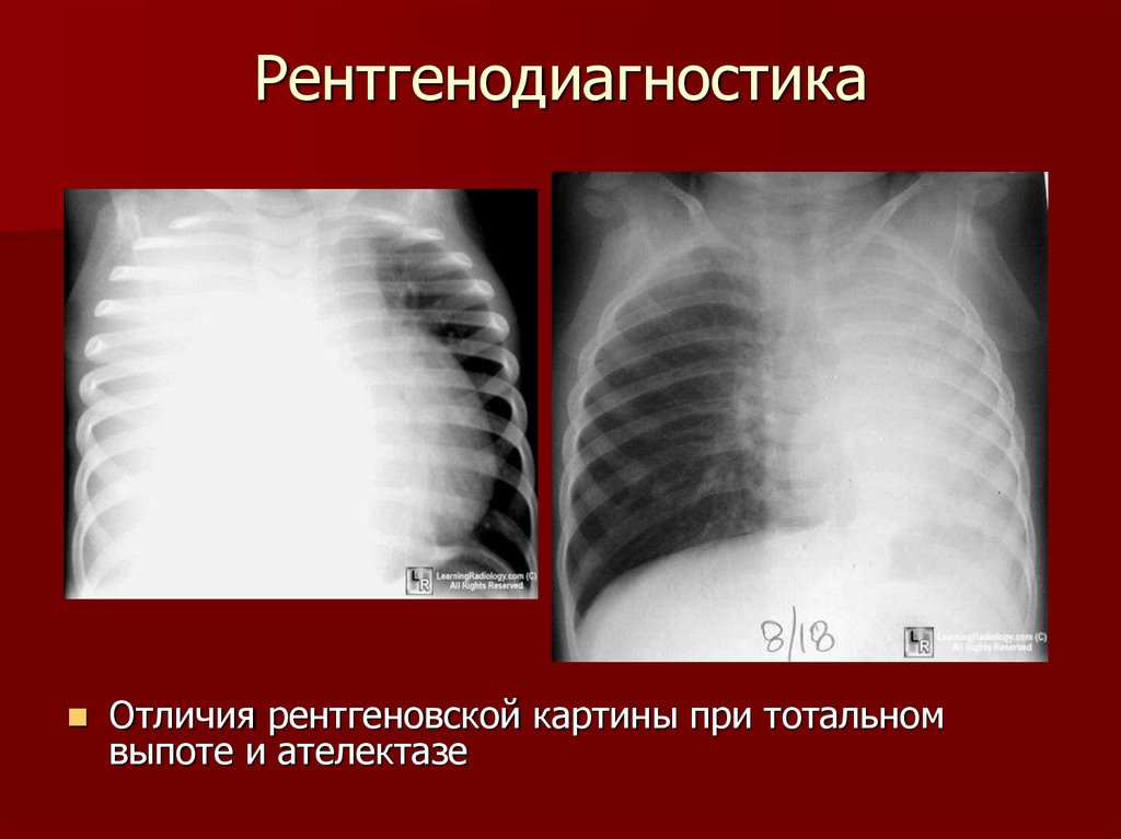 Перисциссурит рентген картина