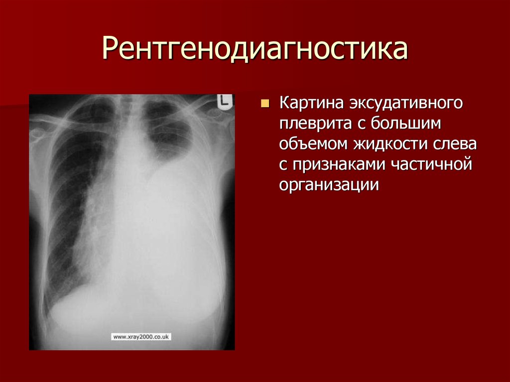 Экссудативный плеврит рентгенологическая картина