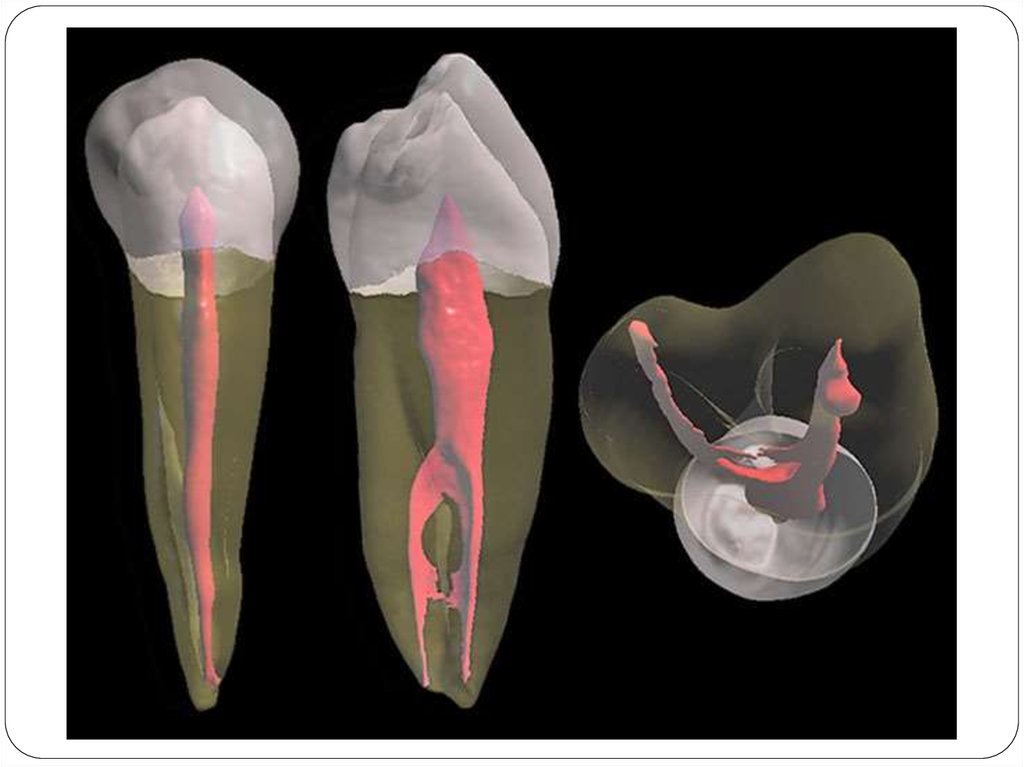 Лечение корневых каналов зубов