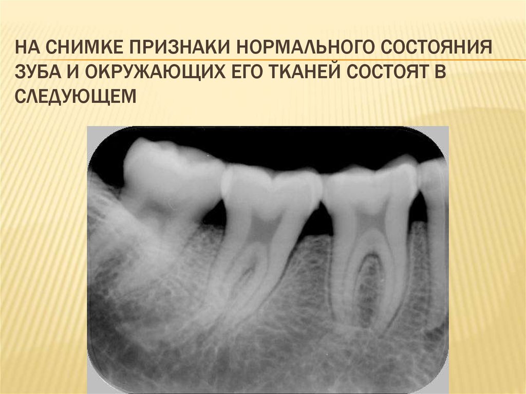 На снимке признаки нормального состояния зуба и окружающих его тканей состоят в следующем