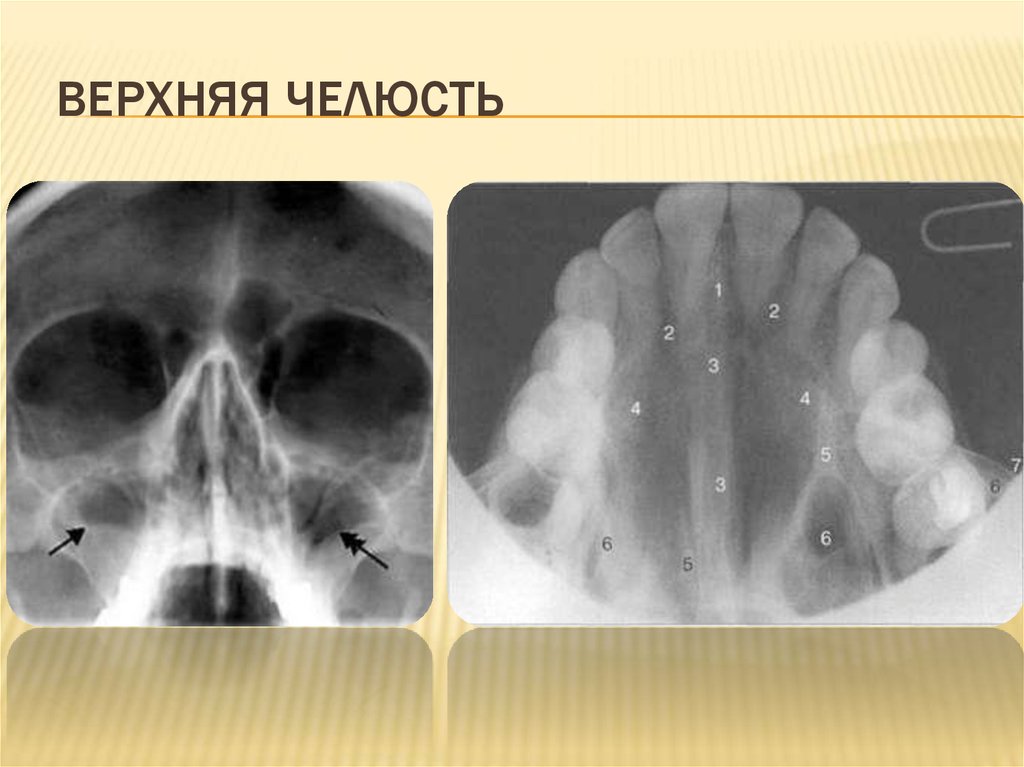 ВЕРХНЯЯ ЧЕЛЮСТЬ